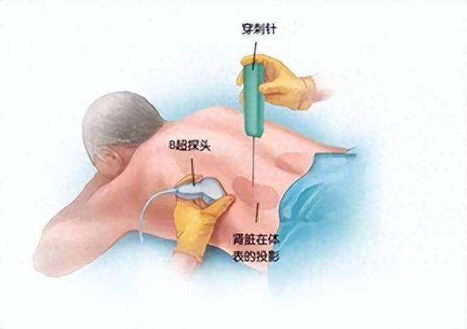 穿刺手术