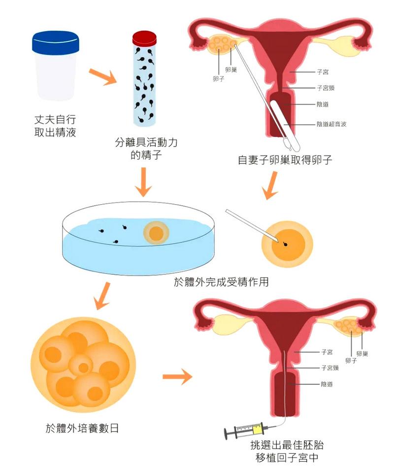 试管婴儿技术