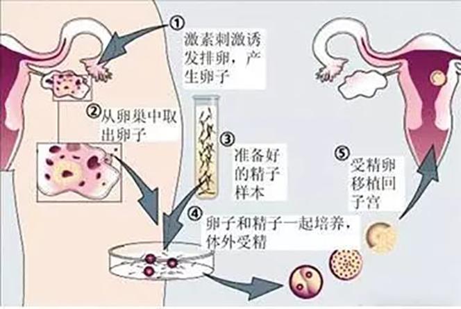 试管婴儿过程中需要进行内膜检查吗？