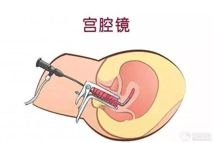 宫腔镜手术