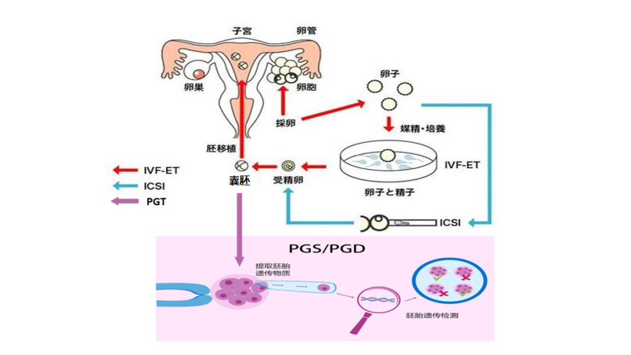 广东三代试管婴儿、试管婴儿技术、生殖医学