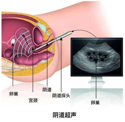 阴道超声