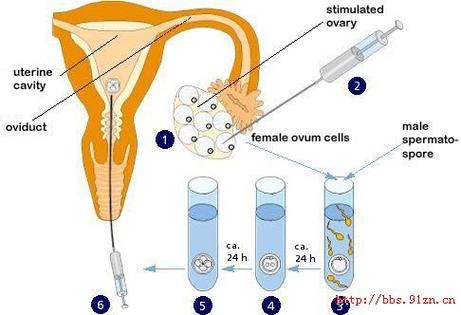 试管婴儿、生殖医学、体外受精