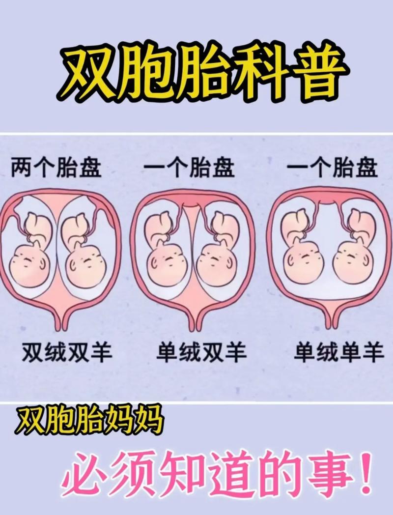 双胞胎判断标准