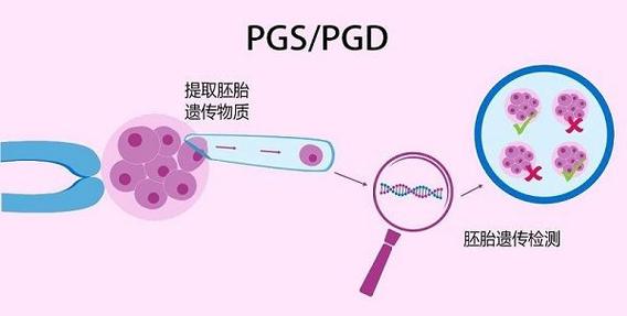 PGD 试管婴儿