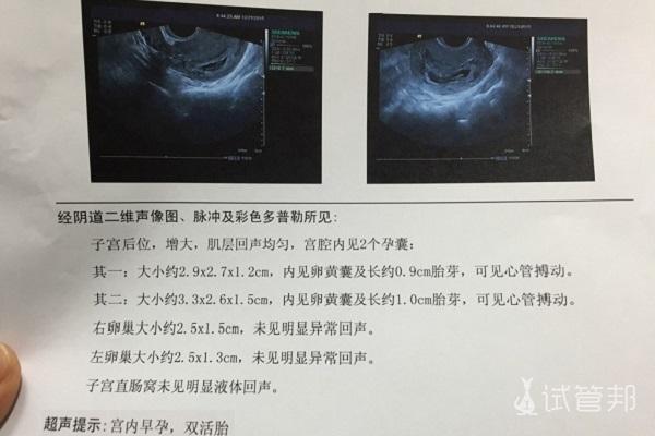 试管婴儿、B 超双胎、生殖医学