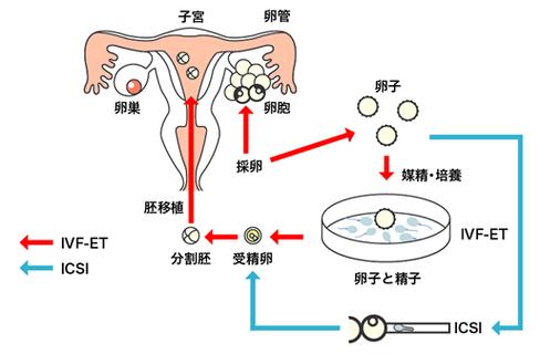 试管婴儿鲜胎技术