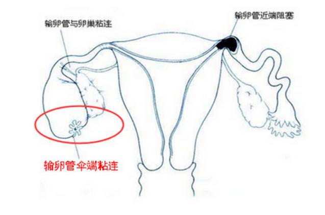 输卵管粘连