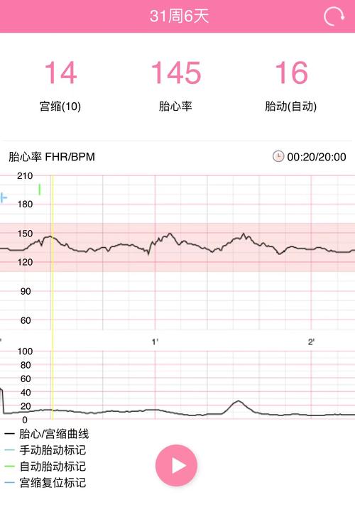 胎心监测