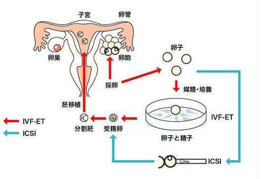  体外受精