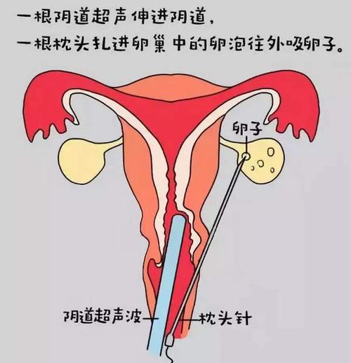 试管婴儿过程中应取几个卵泡最为理想？