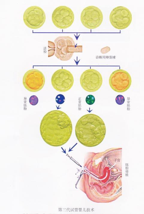 试管婴儿技术种类