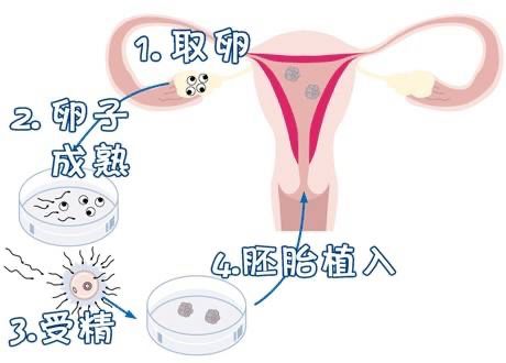 试管婴儿移植过程的疼痛感究竟如何？