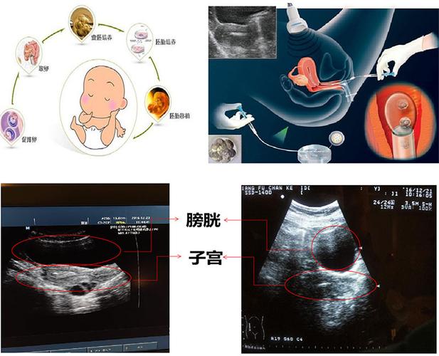 试管婴儿移植过程详解：从哪里进行移植？