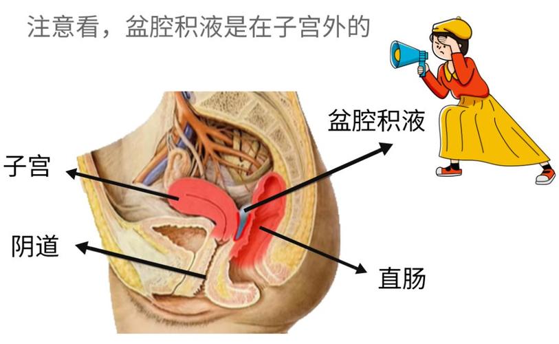 盆腔积液