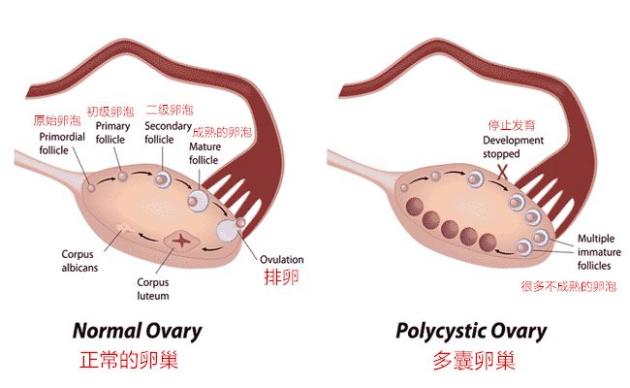 多囊卵巢