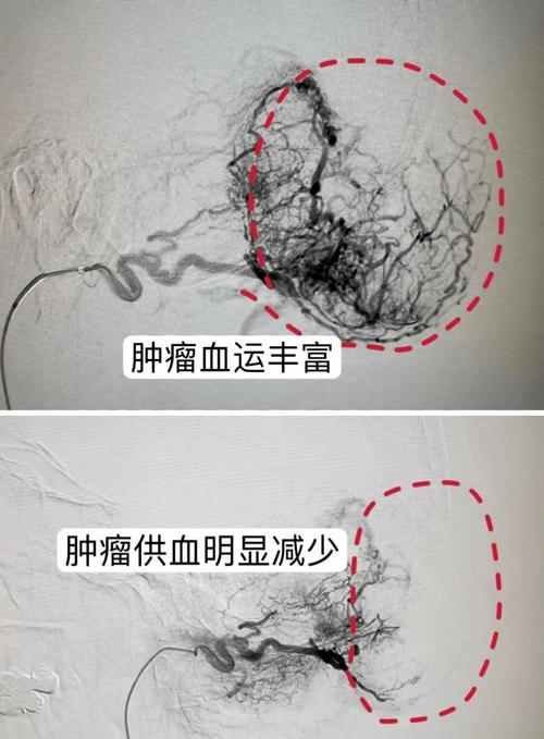 血运丰富