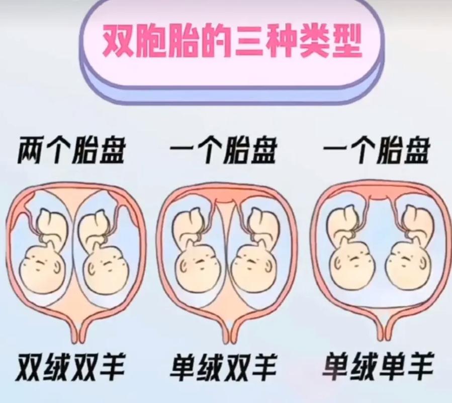 双胞胎判断