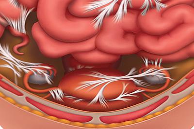 盆腔粘连