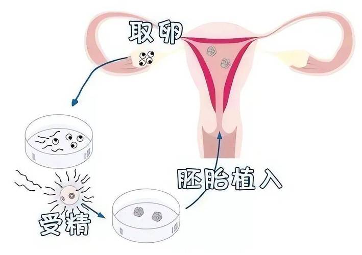 试管婴儿、胚胎植入、生殖医疗