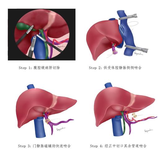 肝脏移植