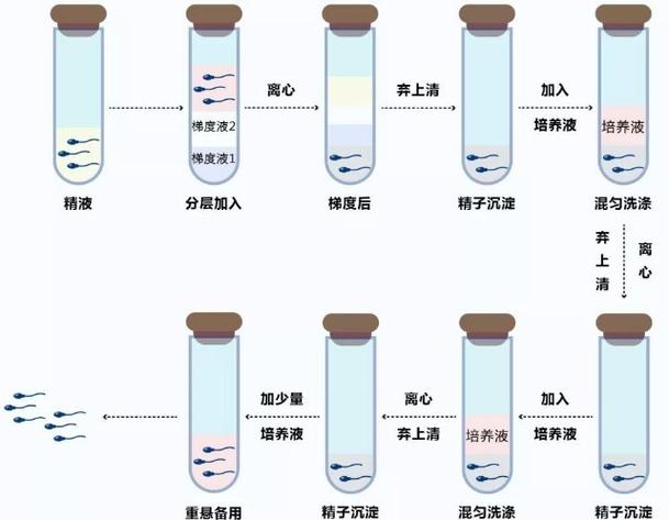  精子洗涤