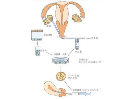 一代试管婴儿是否需要使用造影技术？