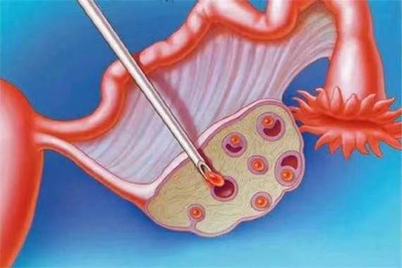 试管婴儿、生殖医学、取卵手术、胚胎移植手术