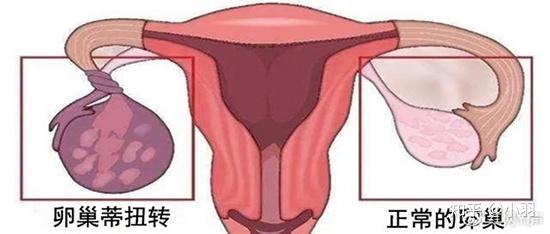 预防卵巢扭转