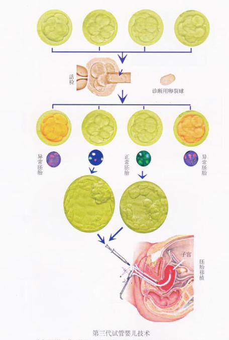  胚胎植入前遗传学筛查