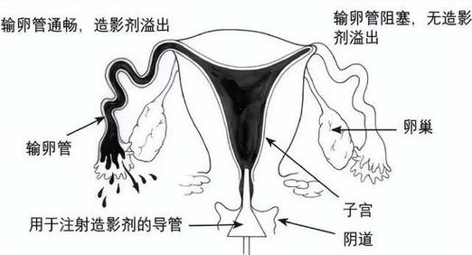 输卵管损害