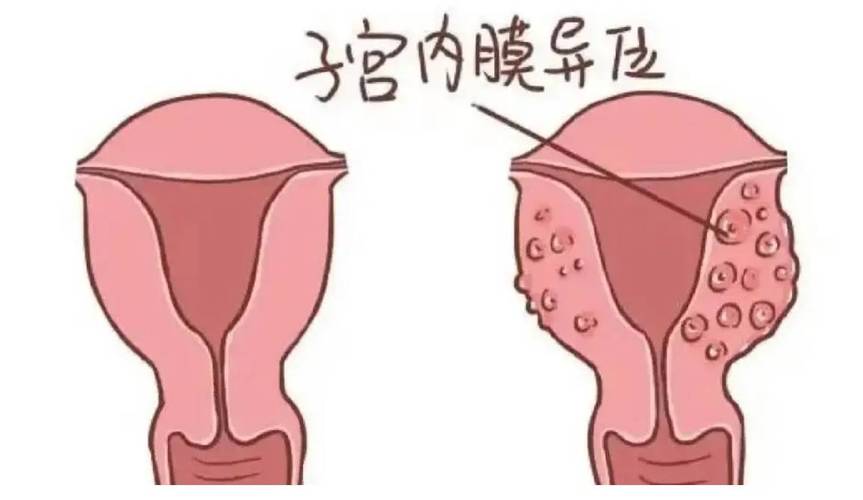 内膜异位症