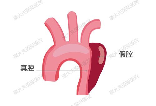 试管婴儿假腔