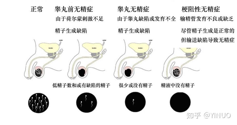 无精症