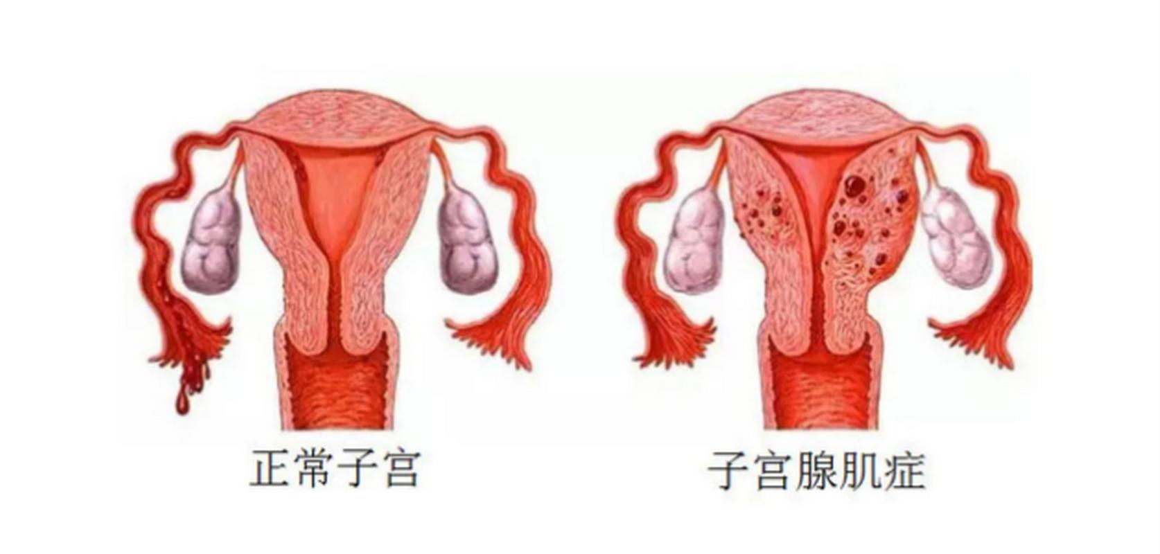 子宫腺肌症