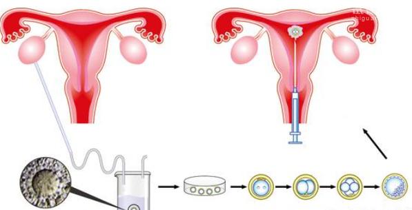 试管婴儿移植到体内的疼痛感究竟如何？