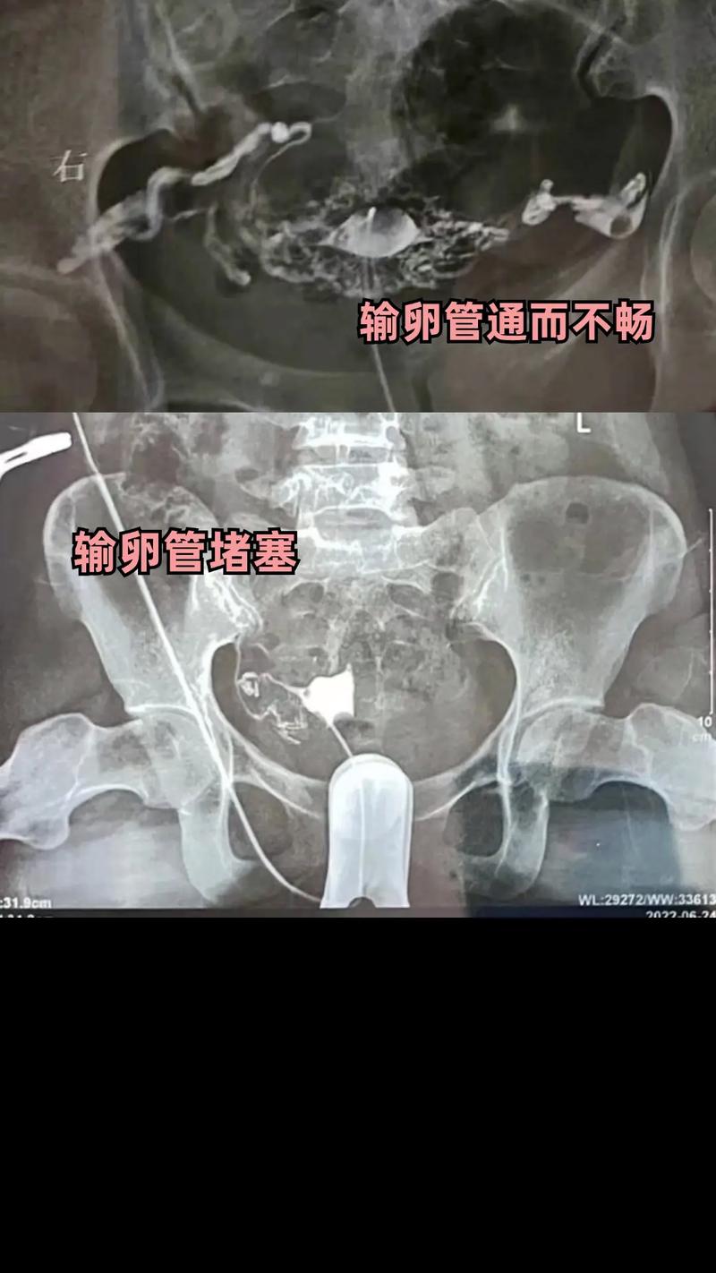 双输卵管不通