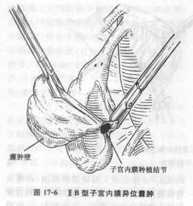  子宫内膜异位囊肿