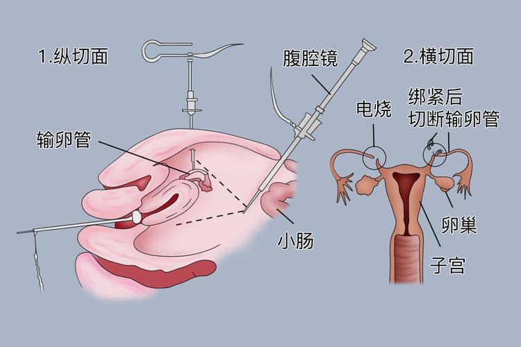 输卵管手术