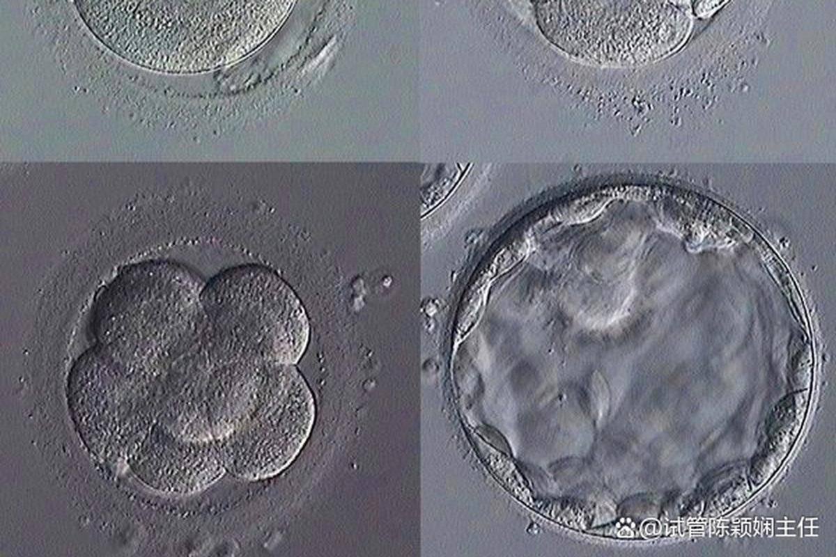 试管婴儿技术：可以同时移植两个胚胎吗？