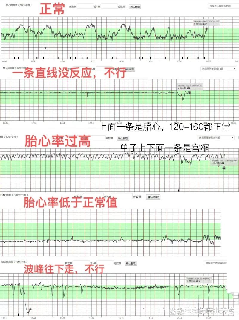 胎心信号