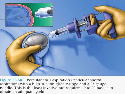 睾丸穿刺取精术
