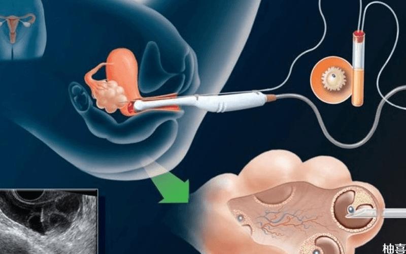 试管婴儿、放胚胎疼痛、生殖医学