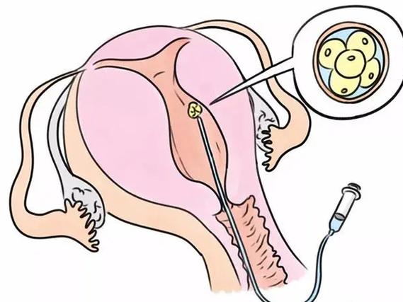 试管婴儿、卵泡取出、医疗生殖