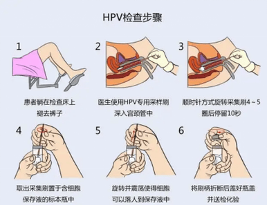 宫颈筛查