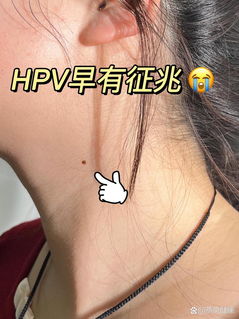 HPV 感染