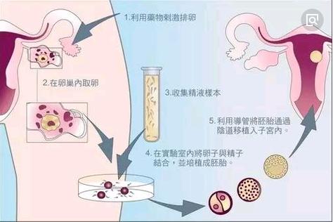  体外受精-胚胎移植(IVF-ET)