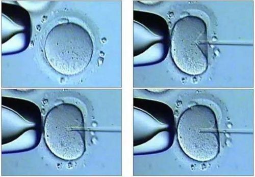 卵母细胞浆内单精子注射。