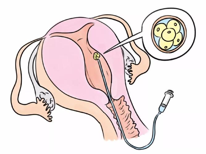 试管婴儿移植、生殖医学、医疗技术