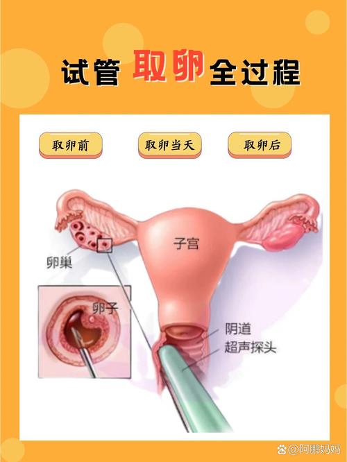 取卵手术并发症